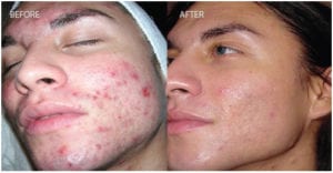INFLAMMATORY ACNE INFLAMMATORY ACNE