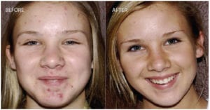 active acne active acne