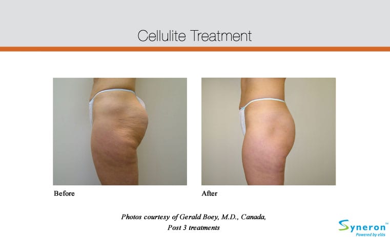 cellulite images