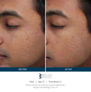 skinpen-male-before-after-1-400x405-296x300 skinpen-male-before-after-1-400x405-296x300