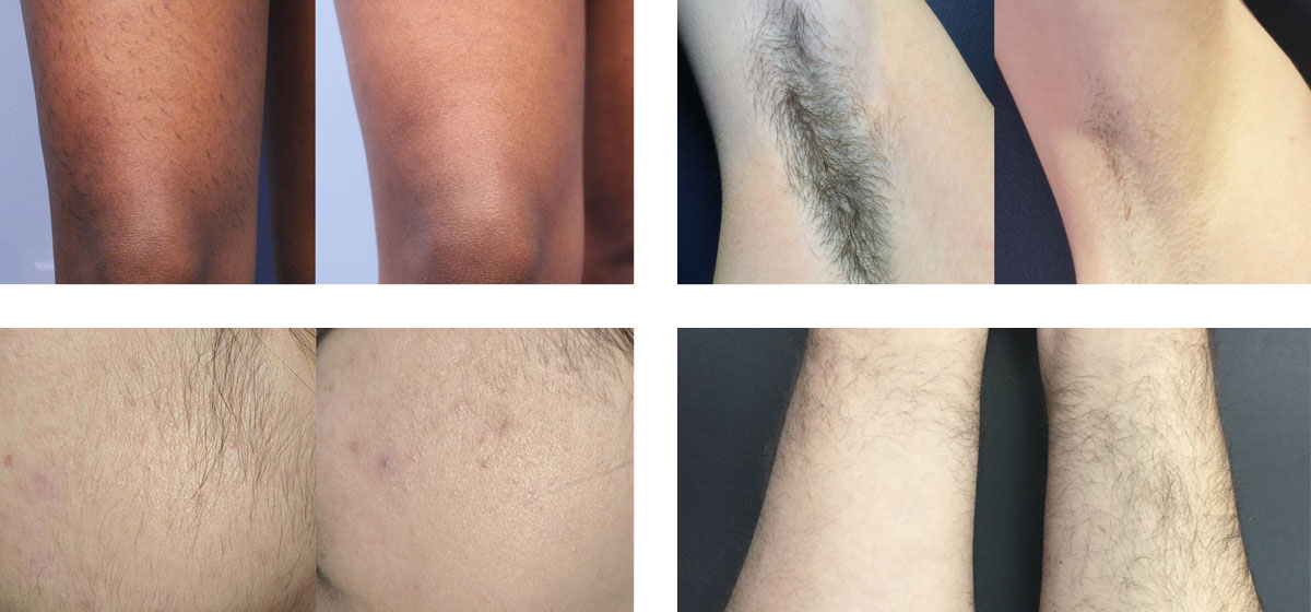 before-after-triton-hair-removal