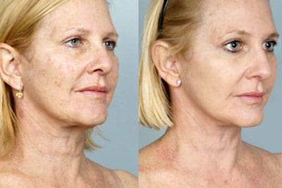 coolpeel-before-after