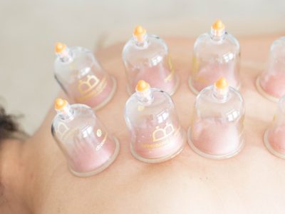 Woman receiving cupping treatment on back