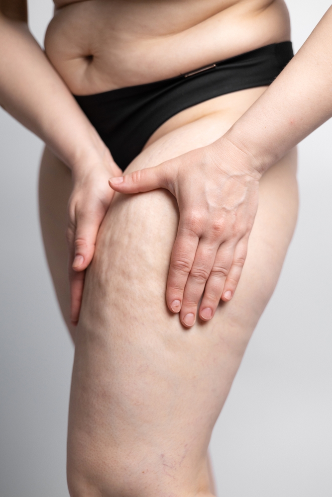 Woman holding and pressing skin on legs to show cellulite and orange peel texture, concept of fat reduction and cellulite treatment.
